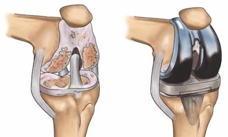 Knee Replacement Surgery in Bhubaneswar